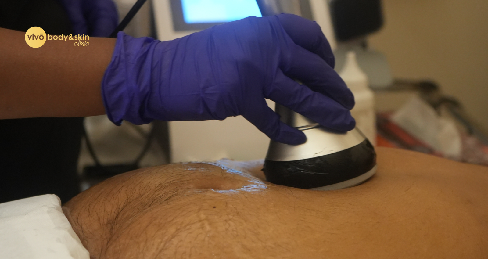 Non-Surgical Abdominal Skin Tightening India: HIFU, RF & Ultrasound