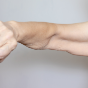Non-Surgical Arm & Shoulder Lift After Weight Loss in India (2026)
