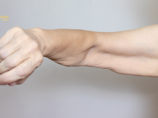 Non-Surgical Arm & Shoulder Lift After Weight Loss in India (2026) 1 Non-Surgical Arm & Shoulder Lift After Weight Loss in India (2026)