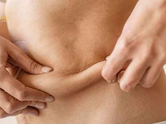 Non-Surgical Skin Tightening After Weight Loss in India 3 Non-Surgical Skin Tightening After Weight Loss in India