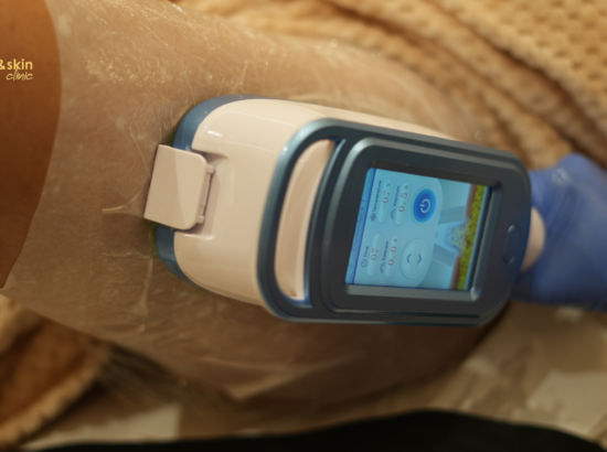 How Many Fat Freezing Sessions Do You Actually Need? 2 How Many Fat Freezing Sessions Do You Actually Need?