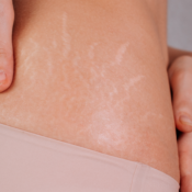 Non-Surgical Stretch Mark Reduction India