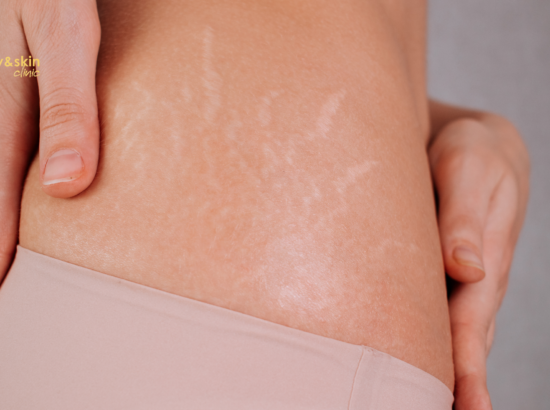 Non-Surgical Stretch Mark Reduction India: Complete Guide