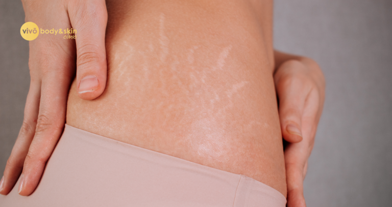 Non-Surgical Stretch Mark Reduction India