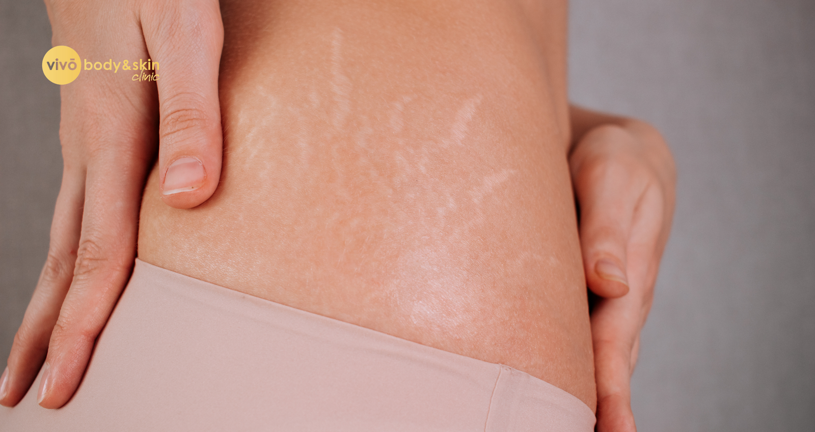Non-Surgical Stretch Mark Reduction India: Complete Guide
